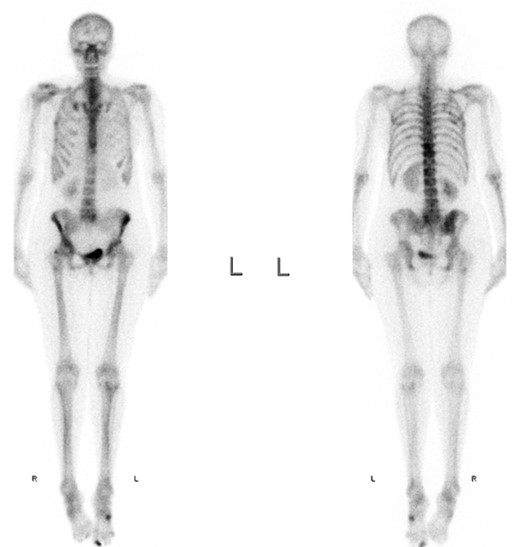 Full-body skeletal scintigraphy.