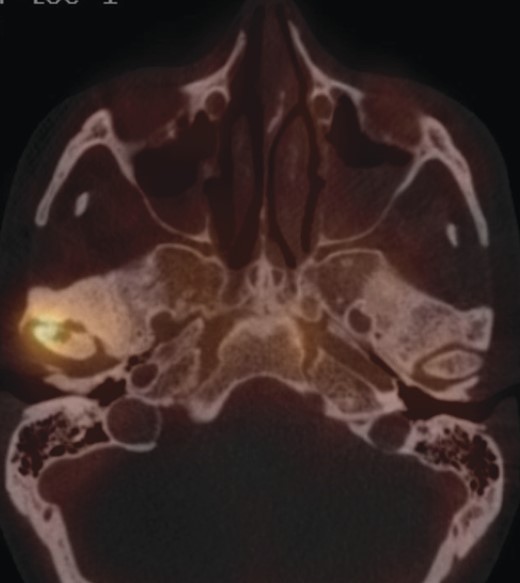 High uptake of nuclides in the right condyle.