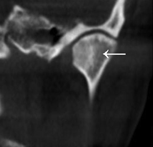 Sclerosis of the left condyle (arrow).