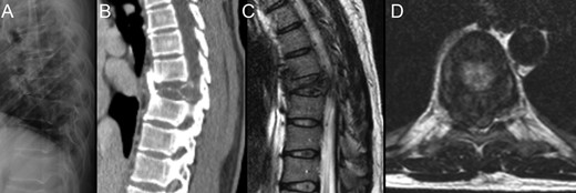 Preoperative imagiologic study; involvement of T8 by the giant-cell tumor as presented in plain radiograph (A), CT scan (B) and MRI (C and D). Notice the tumor mass protruding into the vertebral canal.