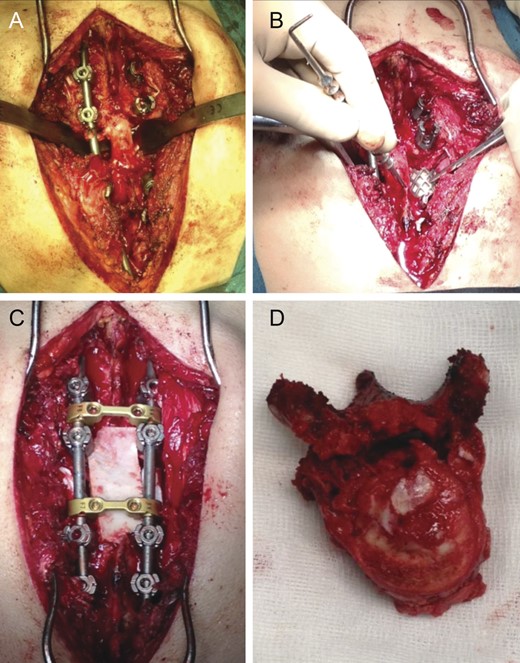 Intraoperative photographs; after total en bloc spondylectomy (A), anterior-column reconstruction was accomplished with placement of a titanium cage with structural allograft (B) and was complemented with pedicle screw-rod fixation (C). (D) Resected vertebra.