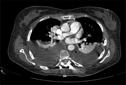 Bilateral hemothorax requiring drainage.