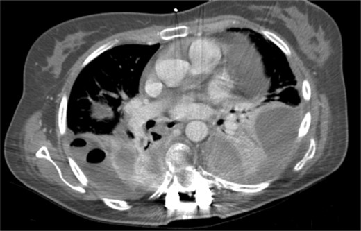 Postoperative thoracic CT scan; large septated empyema, extending from the surgical site to both pleural cavities, was found to be the cause of deterioration of the patient's general condition.