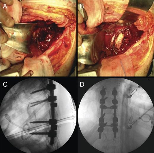 Revision procedure; a thoracotomy was performed for pus drainage and debridement, as well as removal of the anterior cage and allograft (A). A tricortical iliac bone autograft was used to maintain anterior-column stability (B). Postoperative radiographic study (C and D).