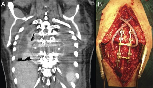 (A) CT scan coronal reconstruction showing recurrence of paravertebral empyema. (B) Intraoperative image following posterior debridement.