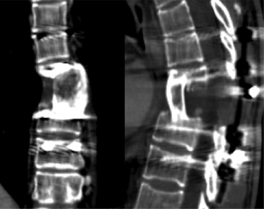 CT scan with no evidence of tumor relapse or instrumentation failure.