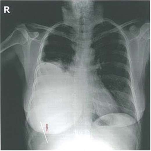Preoperative X-ray.