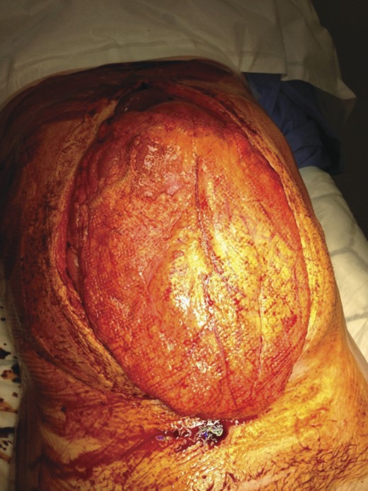 Defect following removal of topical negative pressure dressing.