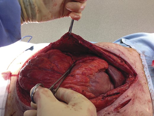 Posterior sheath released from rectus.