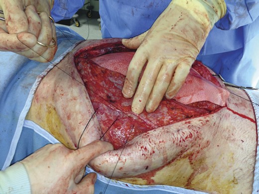 The mesh is sutured to the abdominal wall.