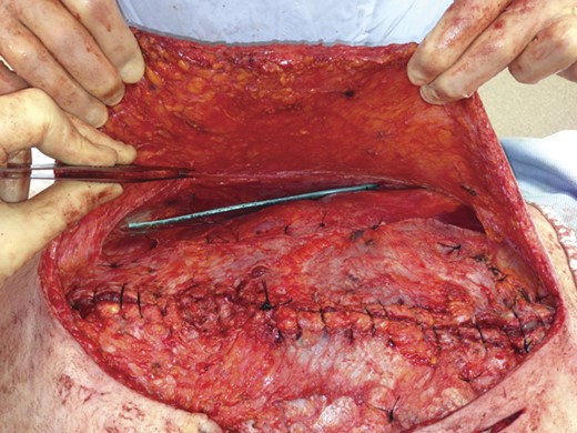 The rectus muscle has been closed, and a drain is placed prior to closing the skin.