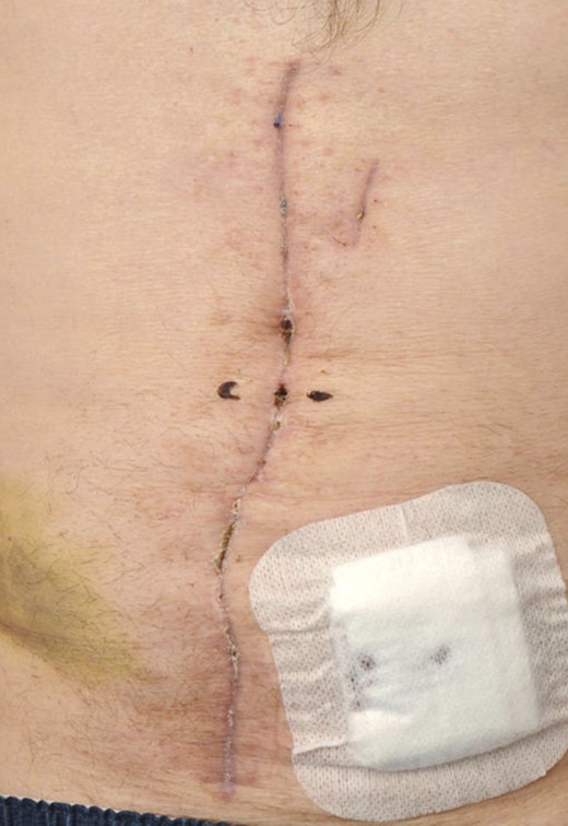 The wound at discharge from hospital.