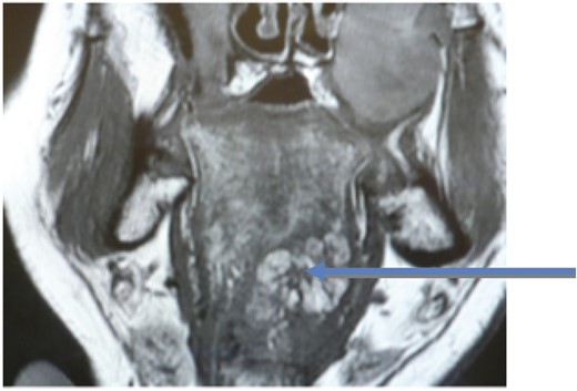 Coronal view MRI with arrow showing the myolipoma at the tongue base.