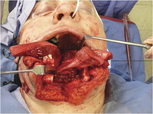 Labiomandibular glossotomy.
