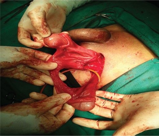 Exploration of left inguinal region revealed both testes with cord structures on the left side.