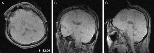 The first intraoperative magnetic resonance images performed after the craniotomy. (A) Axial, (B) coronal and (C) sagittal T1-weighted scout images show the left frontal tumour. The time of scan is superimposed.
