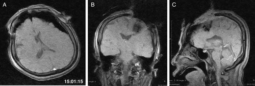 The second iMRI was performed after the tumour resection. (A) Axial, (B) coronal and (C) sagittal T1-weighted scout images show no intracranial haemorrhage. The time of scan is superimposed.