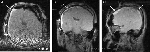 The third intraoperative magnetic resonance images after intubation, axial (A), coronal (B) and sagittal (C) T1-weighted scout images show acute right-sided subdural hematoma (arrows), contralateral to the site of the craniotomy. The time of scan is superimposed.