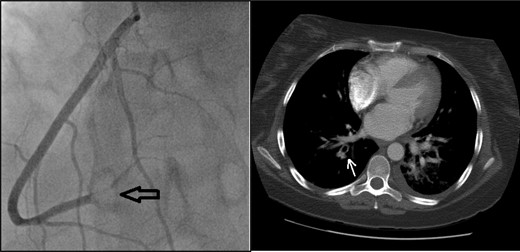 Coronary angiogram (left): note the visible blockage in the distal right coronary artery (black arrow). CT thorax (right): pulmonary embolus in the subsegments of the right upper lobe (white arrow).