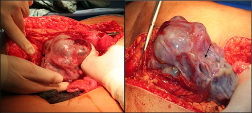 Intraoperative picture of the tumour mass. Note the spontaneous rupture site denoted by the arrow.