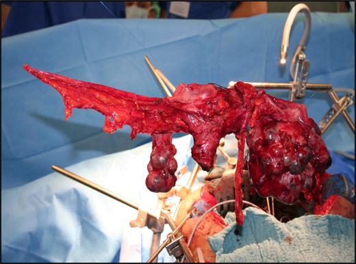 En bloc resection: hysterectomy, BSO, pelvic peritoneum.