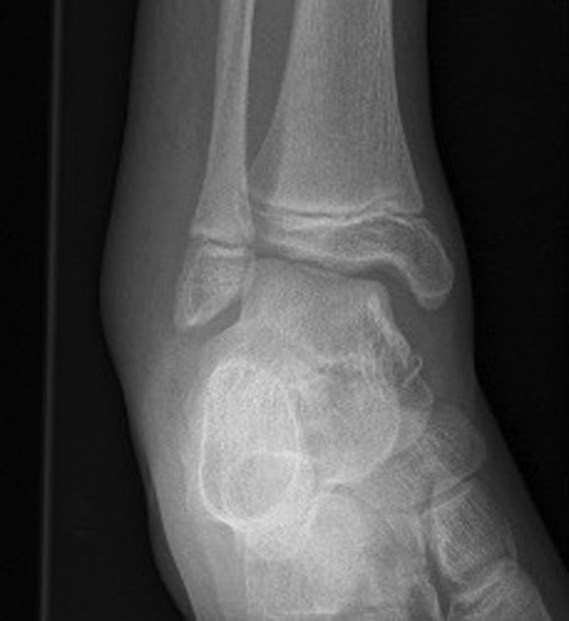 Right ankle plain radiograph demonstrating talar tilt and increased medial tibio-talar joint space.