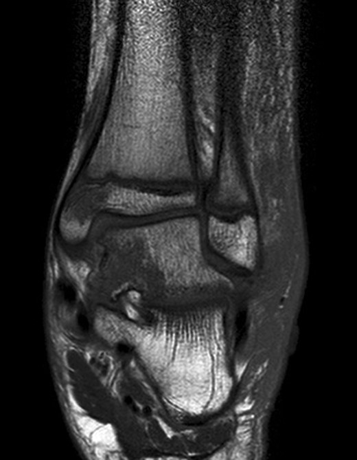 Right ankle MRI coronal view demonstrating bone marrow oedema in the medial malleolus and medial body of talus.