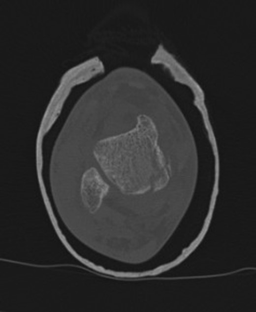Right ankle CT axial view demonstrates undisplaced compression fracture of the medial body of the talus.