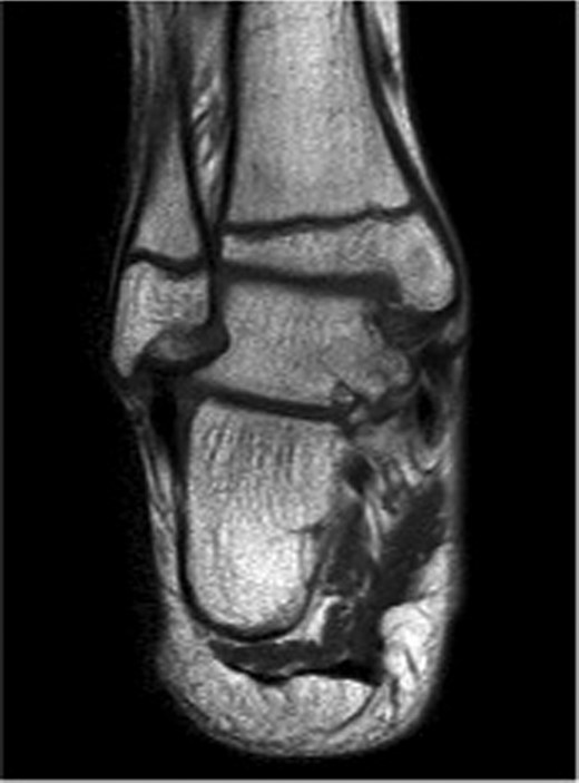 12-week follow-up MRI scan confirms reduction in bone marrow oedema in injured medial tibio-talar joint.