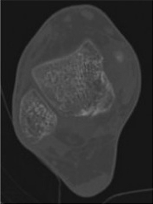 12-week follow-up CT axial view of the talus confirms no further displacement of the fracture nor any evidence of osteonecrosis. There is radiological evidence of callus bridging the fracture site.