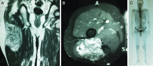 Coronal (A) and axial (B) T2-weighted fat-suppressed images showing the encapsulated soft tissue mass within the right gluteus maximus muscle; (C) whole-body bone scintigraphic image.