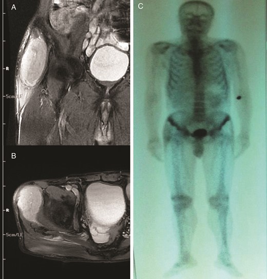 Coronal (A) and axial (B) T2-weighted axial magnetic resonance image of the right gluteus medius muscle showing avid enhancement of the soft tissue component. (C) Total body bone scan image.