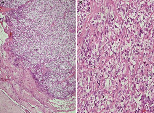 (A) Light microscopic image showing malignant cells with clear cytoplasm invading the surrounding soft tissue and skeletal muscle (H&E staining, original magnification ×100) (A) and (B) light microscopic image (H&E staining, original magnification ×400) showing malignant cells with clear cytoplasm and pleomorphic vesicular nuclei.