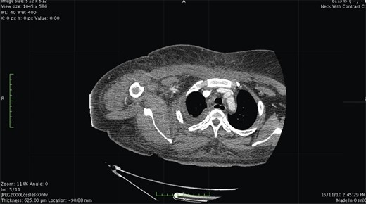 Contrast-enhanced CT. At level of the mediastinum shows extensive inflammation involving the fat and the muscles on the right side.