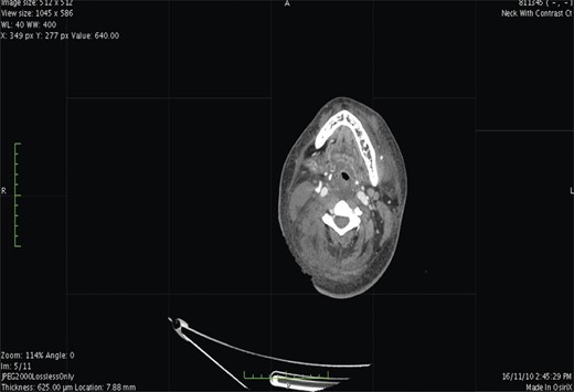 Contrast-enhanced CT. At the level of base of skull shows airway luminal narrowing.