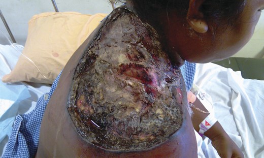Wound after first debridement.