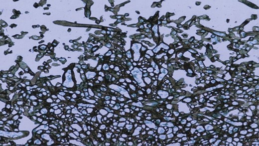 PAS stain showed clusters of broad aseptate fungal hyphae. (10× magnification).