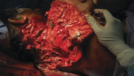 Wound after second debridement.