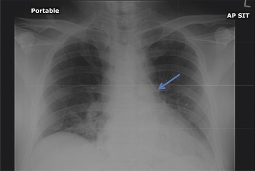 Chest radiograph demonstrates a pneumomediastinum (arrowhead).