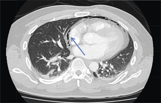 Axial section CT pulmonary angiogram shows a pneumomediastinum (arrowhead).