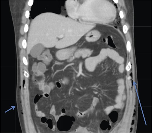 Coronal section CT abdomen scan demonstrates tracking of subcutaneous emphysema (arrowheads).