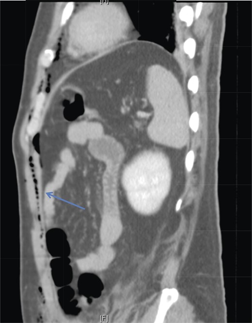 Sagittal section of CT abdomen demonstrates air tracking along the anterior extraperitoneal space (arrowhead) into the anterior mediastinum and preperitoneal fat.