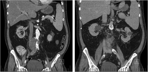 Coronal CT images indicating enlarged aneurysm sac (left) and para-aortic fat stranding (right) representing periaortitis.