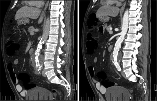Sagittal CT images indicating enlarged aneurysm sac (left) and para-aortic fat stranding (right) representing periaortitis.