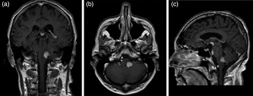 Gadolinium-enhanced T1-weighted MRI images (panes lettered with coronal (a), axial (b) and sagittal (c) sections) showing a homogenous enhancement of a clearly demarcated lesion in the left posterior and lateral midbrain with extension into the inferior cerebellar peduncle.