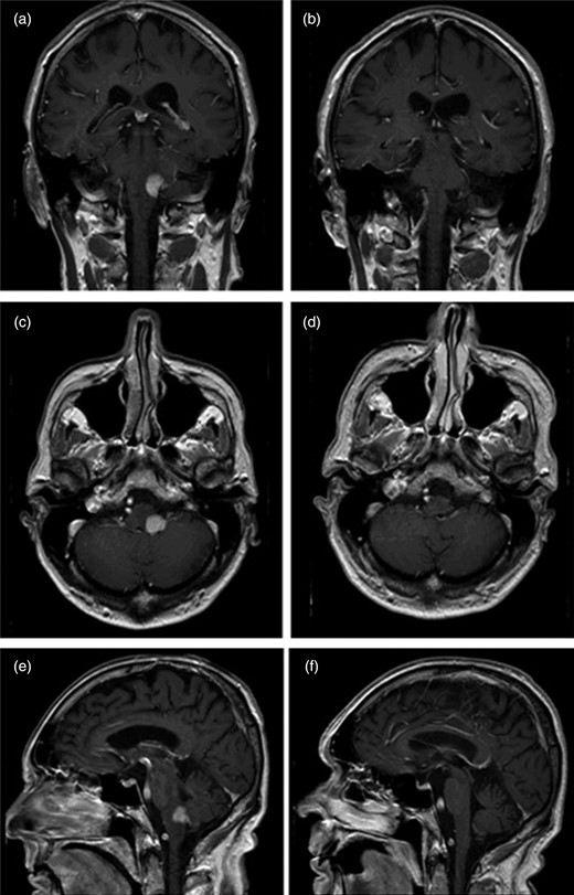 Compares initial T1-weighted gadolinium-enhanced MRI images (seen in panes on left hand side: a, c and e) with those taken following completion of treatment (panes on right: b, d and f). Radiological remission is shown in the post-treatment images.