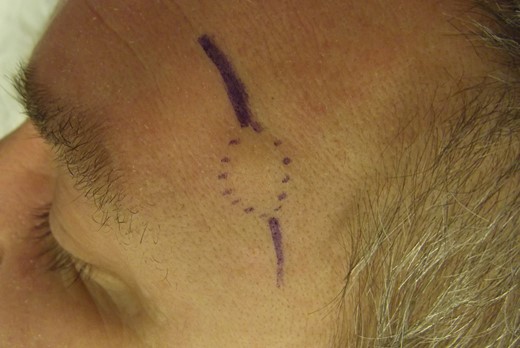 Clinical presentation of a lump on the scalp with a diameter of 1 cm.
