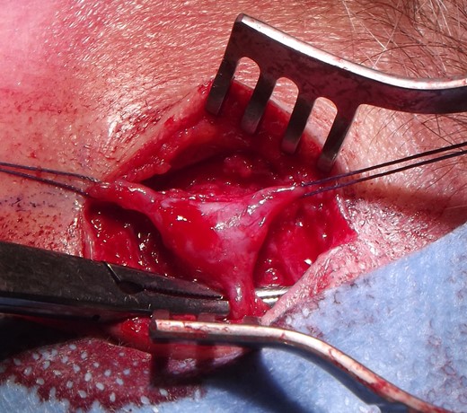 Operative image of a STA aneurysm.