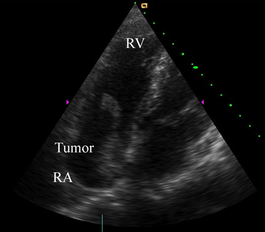 Preoperative transthoracic echocardiography. The right atrial tumor (40 × 20 mm) originated from the interatrial septum. The tumor had a tail-like surface projection, which prolapsed into the right ventricle during diastole. RV, right ventricle; RA, right atrium.