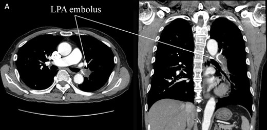 Preoperative CT. (A) Cross section and (B) coronary section. A large embolus stuck into the left pulmonary artery (LPA). The embolus formed acute angles with the vessel wall, which suggested an acute pulmonary embolism.